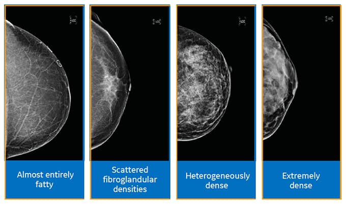 Women often ask how to diagnose dense breast tissue. “How is